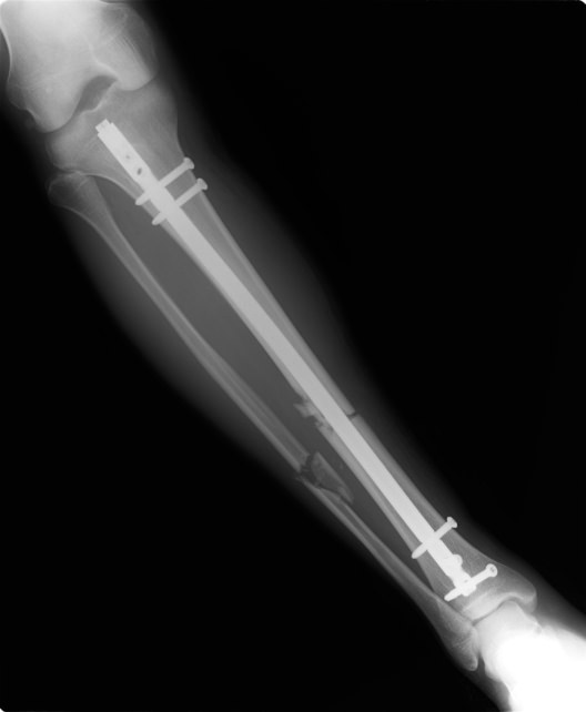 脛骨腓骨骨折 髄内釘 抜釘手術の費用や治療後の経過についてレポート にちプチ Nichi Petit